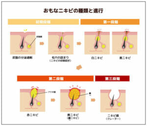 ブラックマヨネーズ吉田の肌