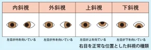 ニューヨーク嶋佐和也の目は斜視